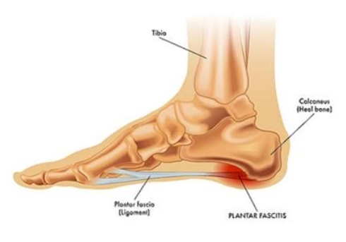 plantar fasciitis