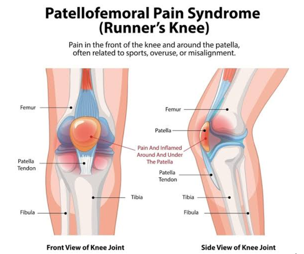 runner's knee