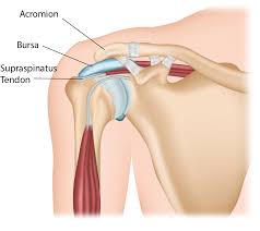 shoulder impingment syndrome
